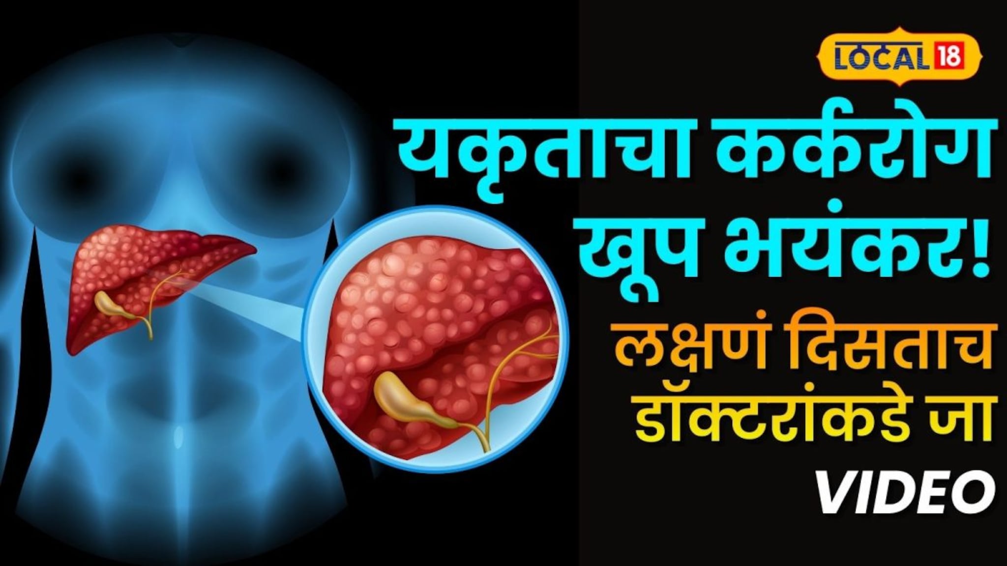 यकृताचा कर्करोग खूप भयंकर! लक्षणं दिसताच डॉक्टरांकडे जा, पोट फुगल्यासारखं वाटलं तर...