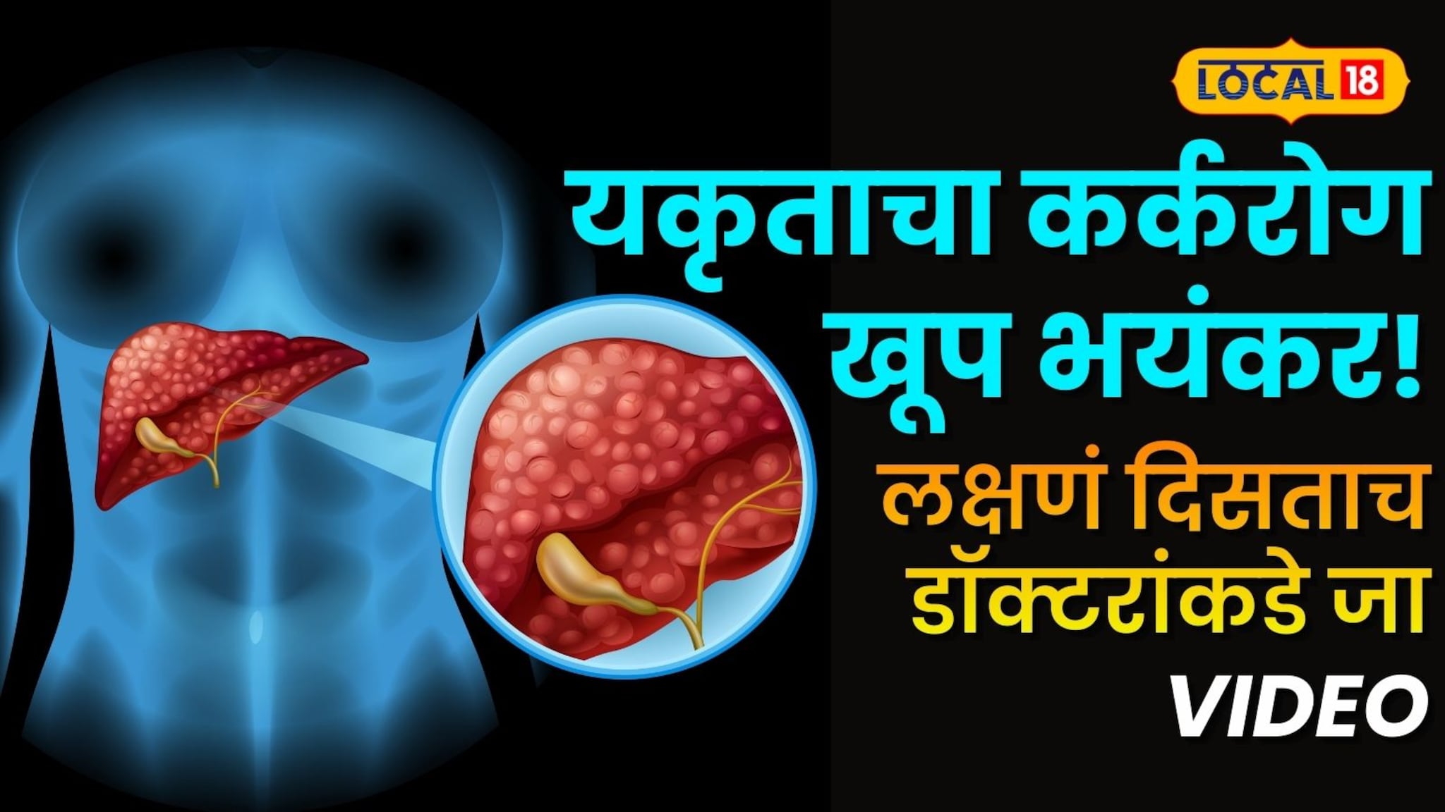 यकृताचा कर्करोग खूप भयंकर! लक्षणं दिसताच डॉक्टरांकडे जा, पोट फुगल्यासारखं वाटलं तर...