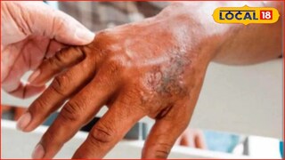 Health: पुन्हा डोकं वर काढतोय महारोग, पुणे विभागातून धडकी भरवणारी आकडेवारी समोर