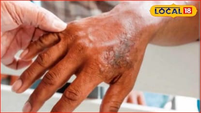 Health: पुन्हा डोकं वर काढतोय महारोग, पुणे विभागातून धडकी भरवणारी आकडेवारी समोर Health: पुन्हा डोकं वर काढतोय महारोग, पुणे विभागातून धडकी भरवणारी आकडेवारी समोर