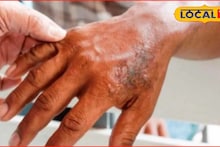 पुन्हा डोकं वर काढतोय महारोग, पुणे विभागातून धडकी भरवणारी आकडेवारी समोर