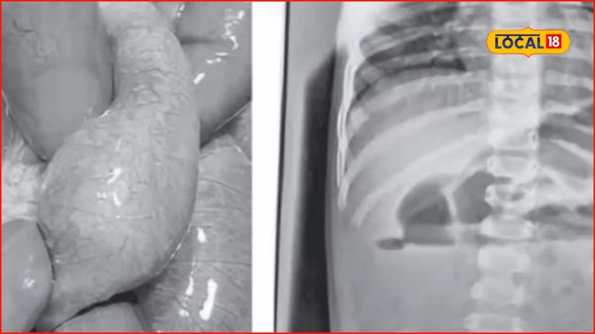 पालकांनो सावधान! 12 महिन्याच्या बाळानं जेली बॉल गिळला, आतड्यात फुगला अन् पुढे जे घडलं...