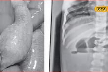 पालकांनो सावधान! 12 महिन्याच्या बाळानं जेली बॉल गिळला, आतड्यात फुगला अन् पुढे जे घडलं...