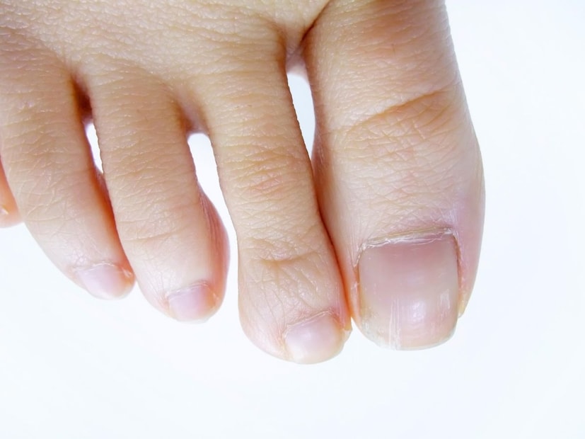 इन्सुलिनचा केसांवर कसा परिणाम होतो?दीर्घकाळ इन्सुलिन प्रतिरोध  किंवा सतत वाढलेली रक्तातील साखर तुमच्या रक्तवाहिन्यांना हळूहळू नुकसान पोहोचवते. जास्त इन्सुलिन आणि ग्लुकोजमुळे रक्तवाहिन्या कडक होतात आणि त्यांच्या लवचिकतेवर परिणाम होतो. यामुळे शरीराच्या दूरच्या भागांमध्ये, जसे की हात-पायांच्या बोटांमध्ये, रक्तपुरवठा कमी होतो.
