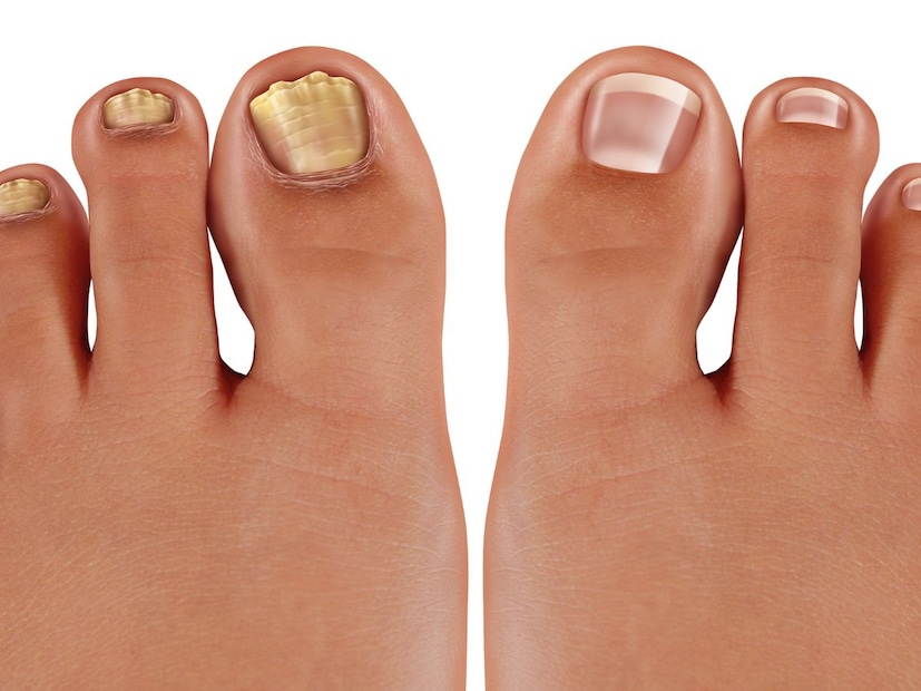 रक्तप्रवाह कमी झाल्यास काय होते?जेव्हा बोटांपर्यंत रक्तपुरवठा कमी होतो, तेव्हा केसांना आवश्यक पोषण मिळत नाही. परिणामी, पायाच्या बोटांवरील केस हळूहळू पातळ होतात किंवा पूर्णपणे गळून जातात. म्हणूनच: पायाच्या बोटांवरचे केस हे तुमच्या रक्तवाहिन्यांचे आरोग्य अप्रत्यक्षपणे दर्शवतात. जर हे केस गळत असतील, तर ते कमी झालेल्या रक्तप्रवाहाचा संकेत असू शकतो, ज्याचा थेट संबंध अनेकदा इन्सुलिनच्या समस्यांशी जोडलेला असतो.