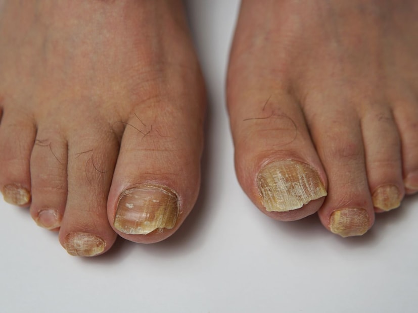 ही लक्षणे दिसल्यास त्वरित डॉक्टरांचा सल्ला घ्याकेवळ केस गळणे हा एकटा आजार नाही, पण जर हे लक्षण खालीलपैकी कोणत्याही लक्षणांसोबत आढळले, तर सावधगिरी बाळगणे आवश्यक आहे.