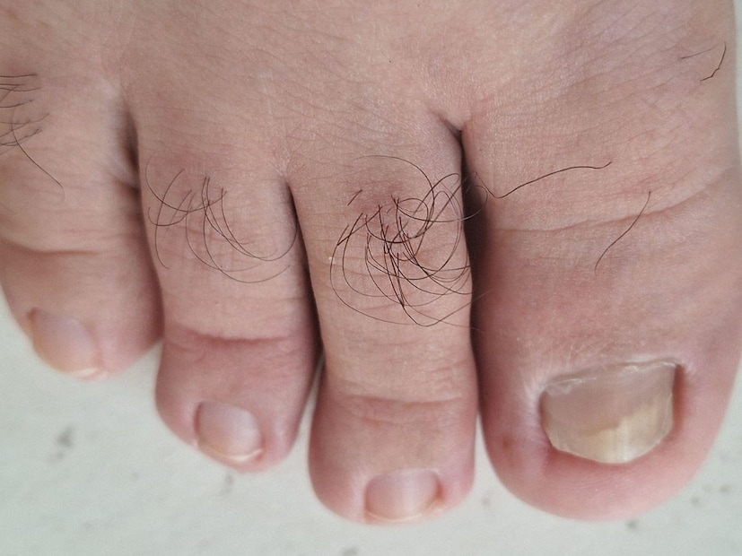 वरीलपैकी कोणतीही लक्षणे पायाच्या बोटांवरील केस गळण्यासोबत दिसत असल्यास, तुम्ही त्वरित तुमच्या डॉक्टरांचा सल्ला घ्यावा आणि रक्तातील साखर (Sugar Levels), इन्सुलिनचे प्रमाण (Insulin Markers) आणि रक्ताभिसरण तपासणी (Circulation Check) करून घेणे आवश्यक आहे. कारण ही लक्षणे मधुमेह (Diabetes) किंवा पेरिफेरल आर्टरी डिसीज (Peripheral Artery Disease) सारख्या समस्यांची पूर्वचिन्हे असू शकतात.