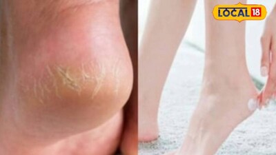 फटी एड़ियों से पाएं छुटकारा! मोमबत्ती का यह घरेलू नुस्खा करेगा कमाल.