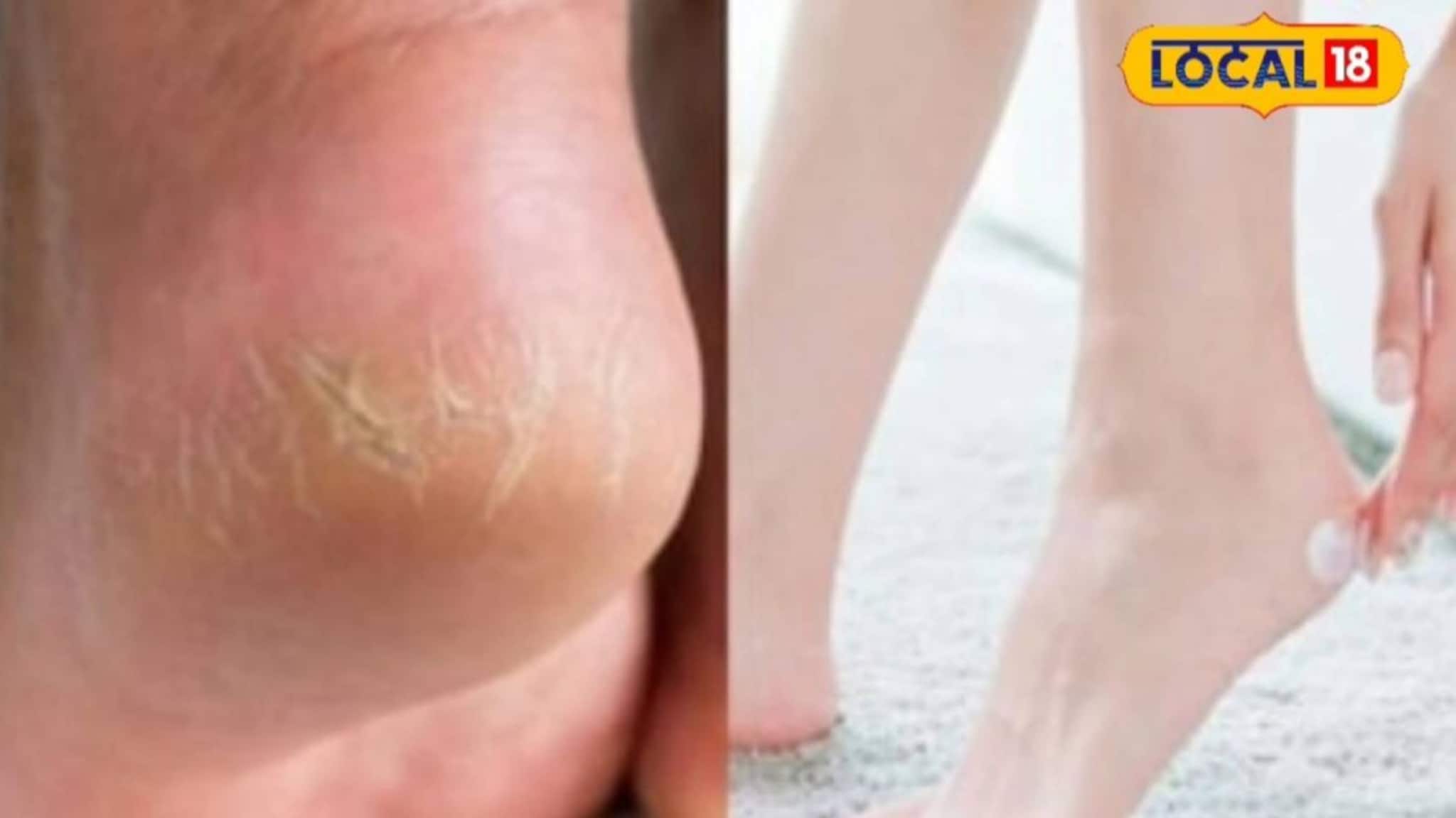 Cracked Heels : पायांच्या भेगा घालवण्यासाठी महागड्या वस्तूंची गरज नाही! 'या' घरगुती उपायाने होतील गायब