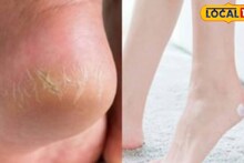 Cracked Heels : पायांच्या भेगा घालवण्यासाठी महागड्या वस्तूंची गरज नाही! 'या' घरगुती उपायाने होतील गायब