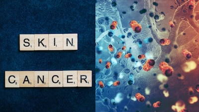 Skin Cancer: Recognize Hidden Symptoms, Understand Causes, Act Early