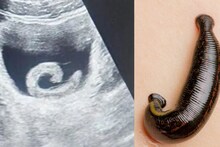 बापरे! इंटरनेटवर पाहिलं आणि व्यक्तीने प्रायव्हेट पार्टमध्ये सोडला जिवंत जळू