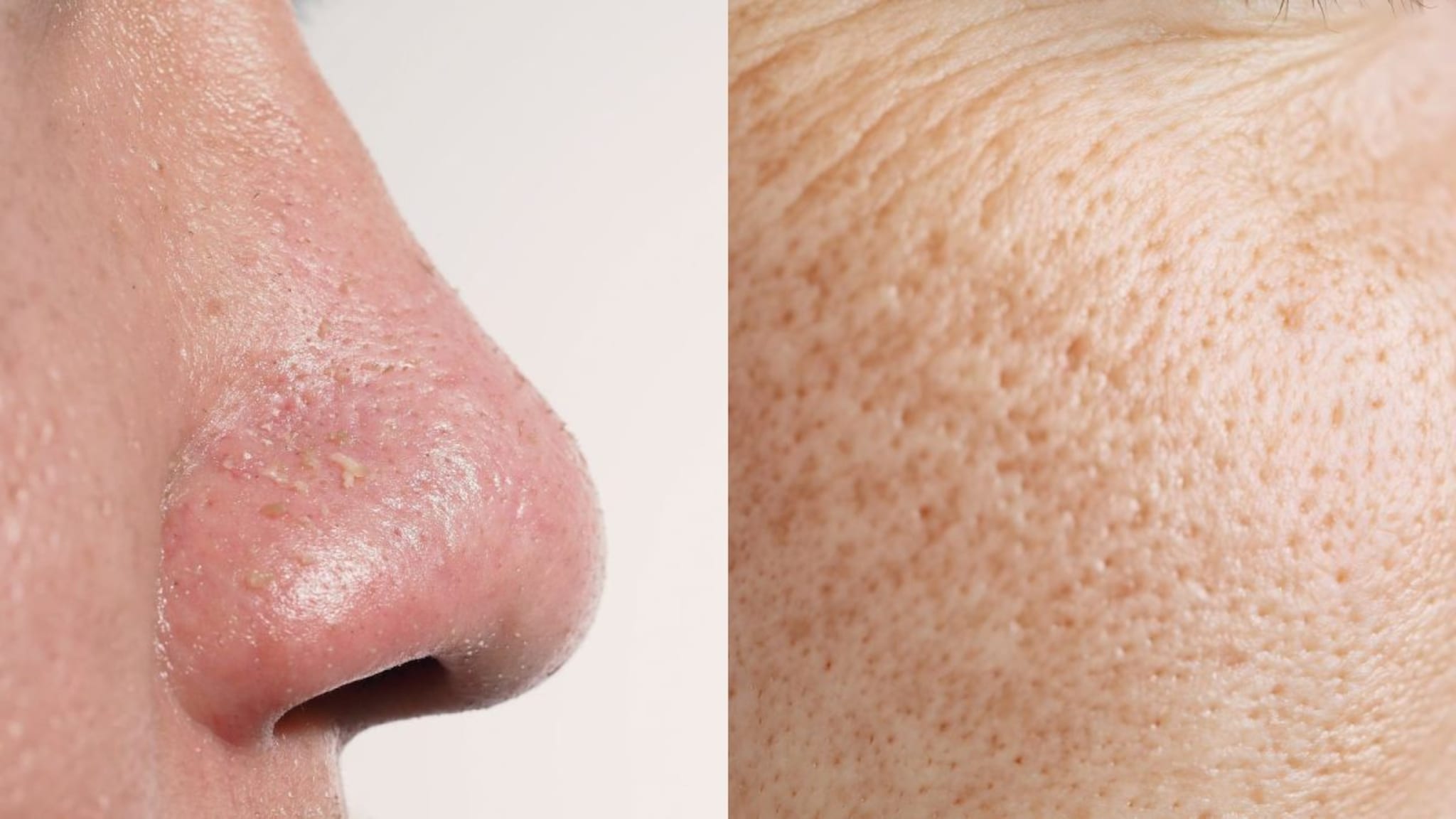 Open Pores : तेलकट त्वचा असलेल्यांसाठी नैसर्गिक पर्याय, चेहऱ्याची त्वचा होईल घट्ट, सहज - सोपे फेस पॅक