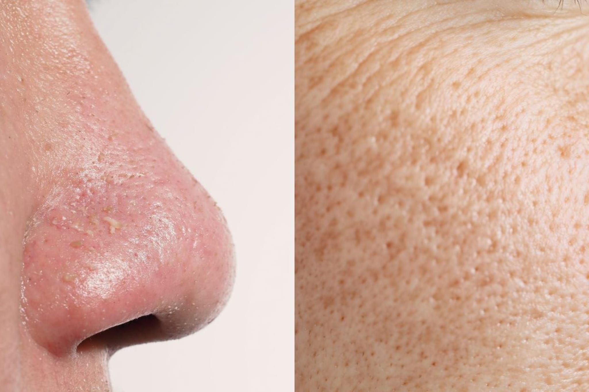 Open Pores : महागड्या फेशियलच्या आधी हे उपाय करुन पाहा, स्वस्त - झटपट फेसपॅक