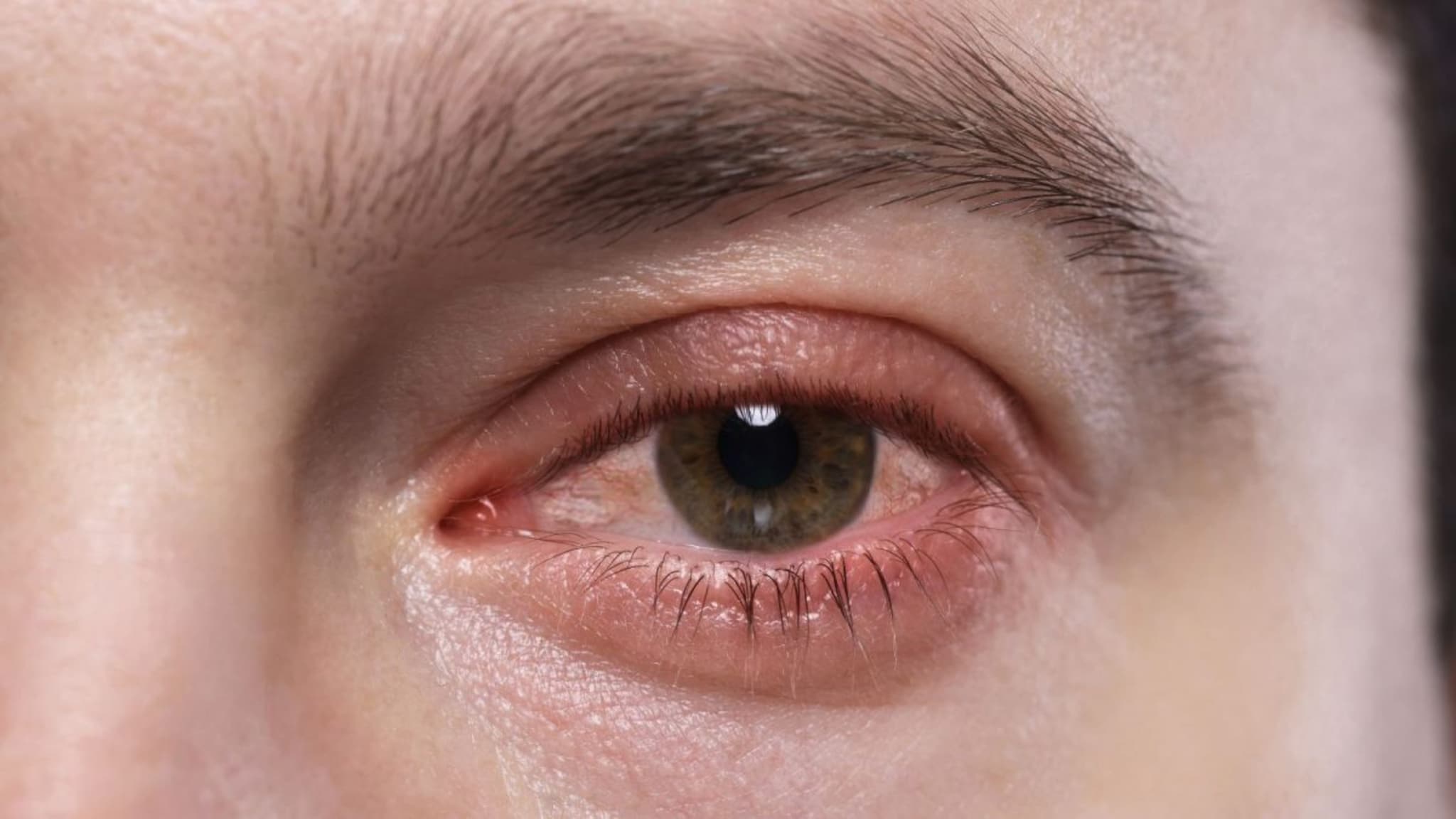 Eye Care : डोळे लाल का होतात ? जाणून घेऊयात कारणं, उपचारांविषयीची माहिती