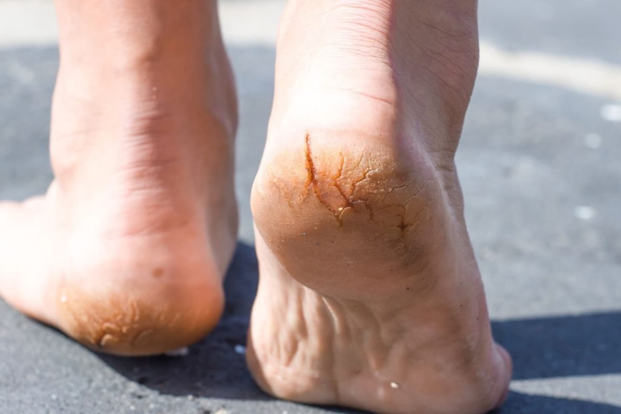 काळजी घेऊनही टाचांना भेगा पडतात? दुर्लक्ष करू नका, असू शकतात 'ही' 8 कारणं! काळजी घेऊनही टाचांना भेगा पडतात? दुर्लक्ष करू नका, असू शकतात 'ही' 8 कारणं!