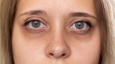 Dark Circles: Natural Remedies to Brighten Dull Skin & Reduce Under-Eye Circles