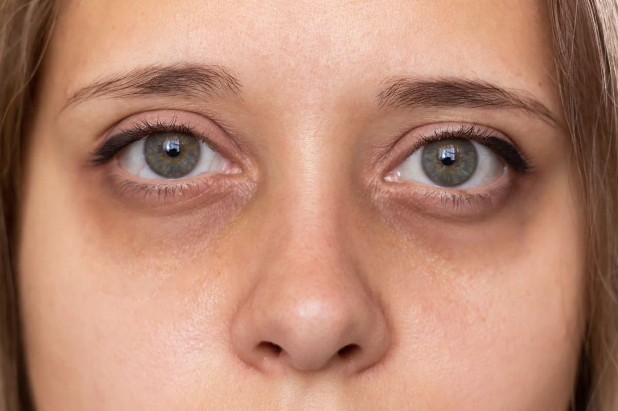 Dark Circles : डोळ्यांखाली काळी वर्तुळं का येतात ? वाचा खास स्किन केअर टिप्स