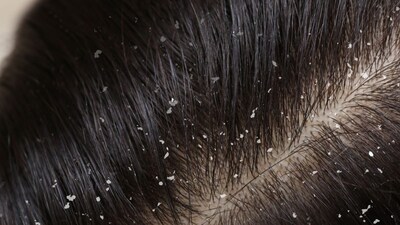 सर्दियों में डैंड्रफ से परेशान? इन आसान घरेलू उपायों से पाएं छुटकारा.