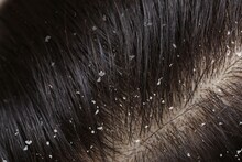 Dandruff : केसातला कोंडा कसा घालवायचा ? वापरुन पाहा सोपे आणि सहज उपाय