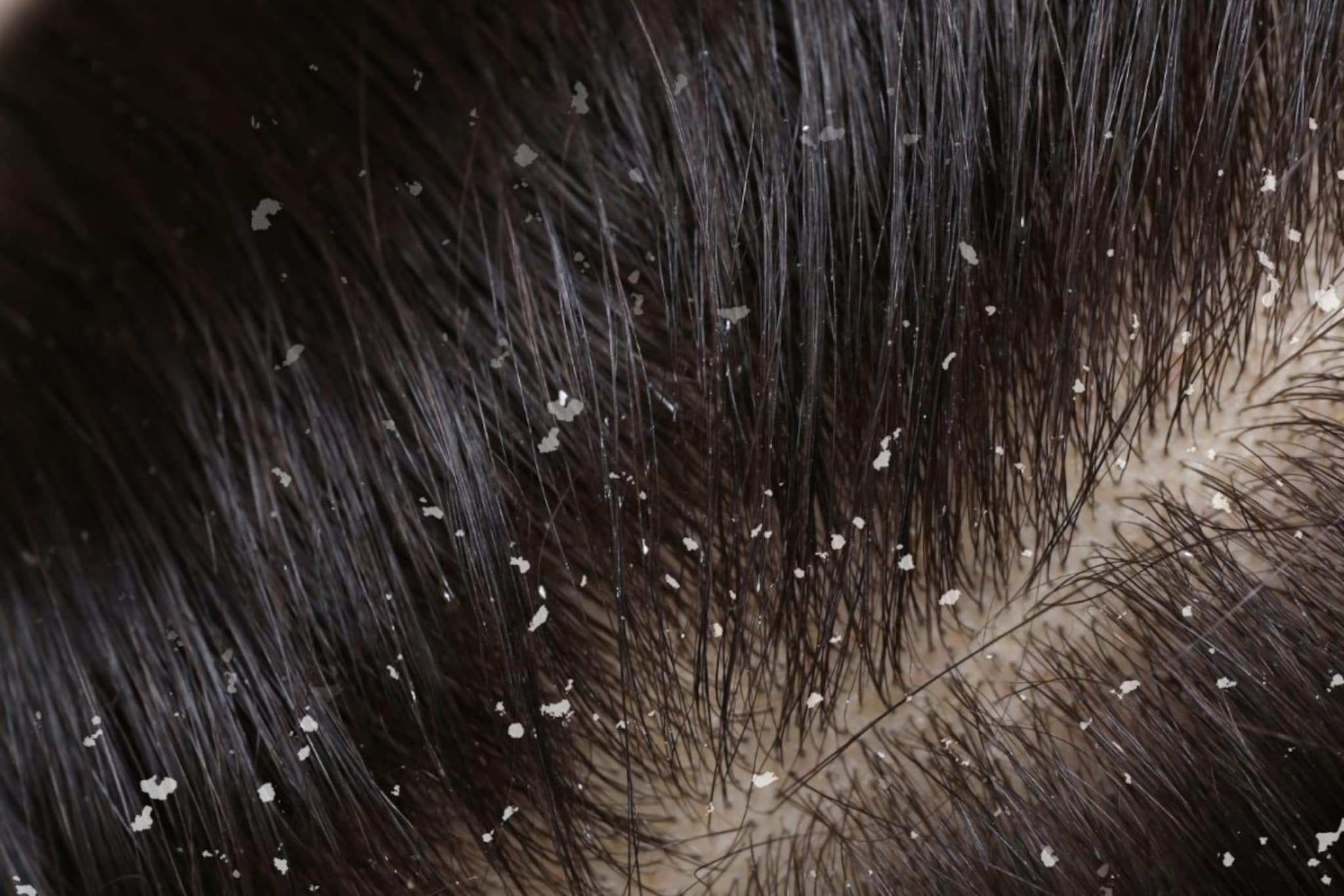 Dandruff : केसातल्या कोंड्यावर घरगुती उपाय, टाळू राहिल स्वच्छ, केस दिसतील सुंदर