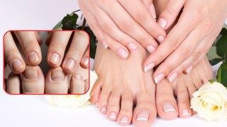 नखांवर पांढरे डाग दिसण्याचा अर्थ काय?