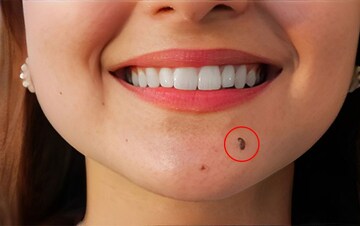 'या' विशिष्ट जागेवर तीळ असणाऱ्यांचा कसा असतो स्वभाव?