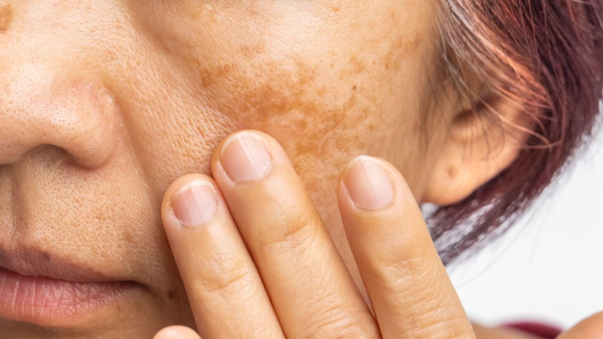 Vang Var Upay : चेहऱ्यावरील वांग घालवण्यासाठी घरगुती उपाय; 'या' 4 गोष्टी करुन तर पाहा