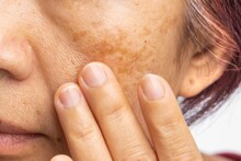 Vang Var Upay : चेहऱ्यावरील वांग घालवण्यासाठी घरगुती उपाय; 'या' 4 गोष्टी करुन तर पाहा