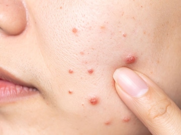 Pimple आणि Acne मध्ये फरक काय? Youtube बघून उपाय करण्यापूर्वी हा फरक जाणून घ्या