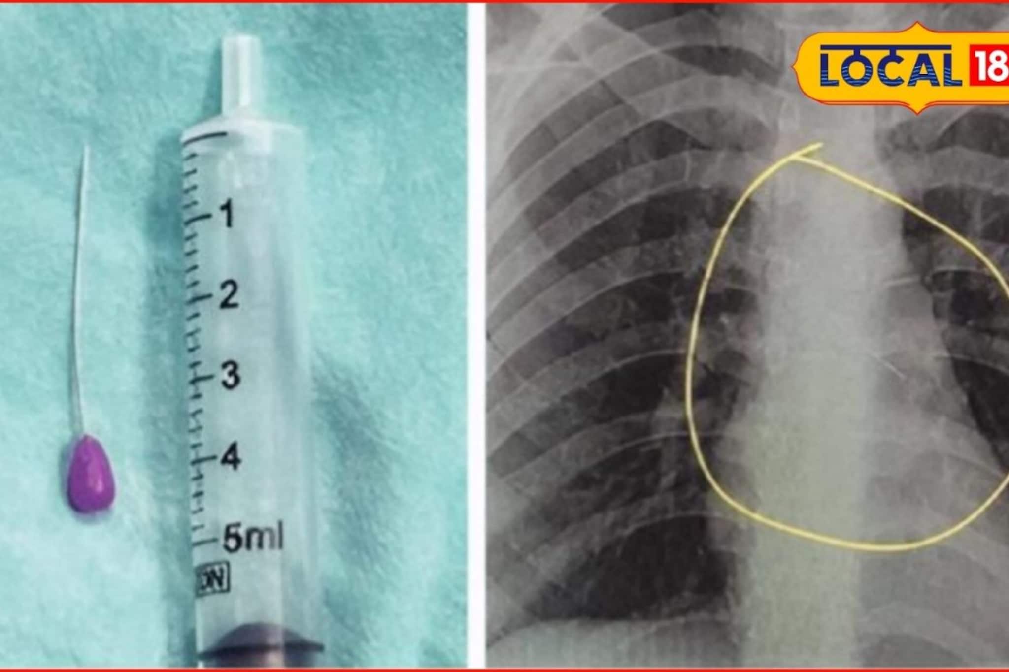 कपडे घालताना तोंडात पिन धरली अन् ठसका आला, काही कळायच्या आत..., तरुणीसोबत भयंकर