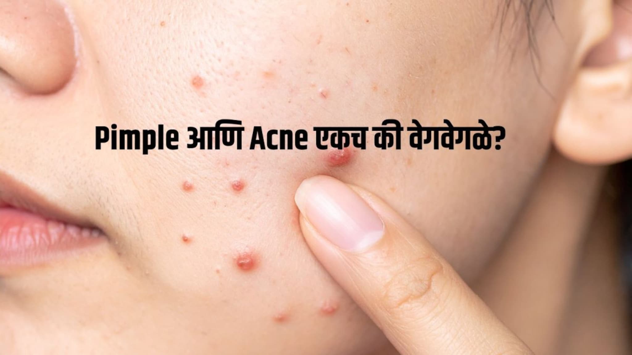 Pimple आणि Acne मध्ये फरक काय? Youtube बघून घरगुती उपाय करण्यापूर्वी 'हा' फरक जाणून घ्या