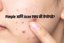 Pimple आणि Acne मध्ये फरक काय? Youtube बघून घरगुती उपाय करण्यापूर्वी 'हा' फरक जाणून घ्या