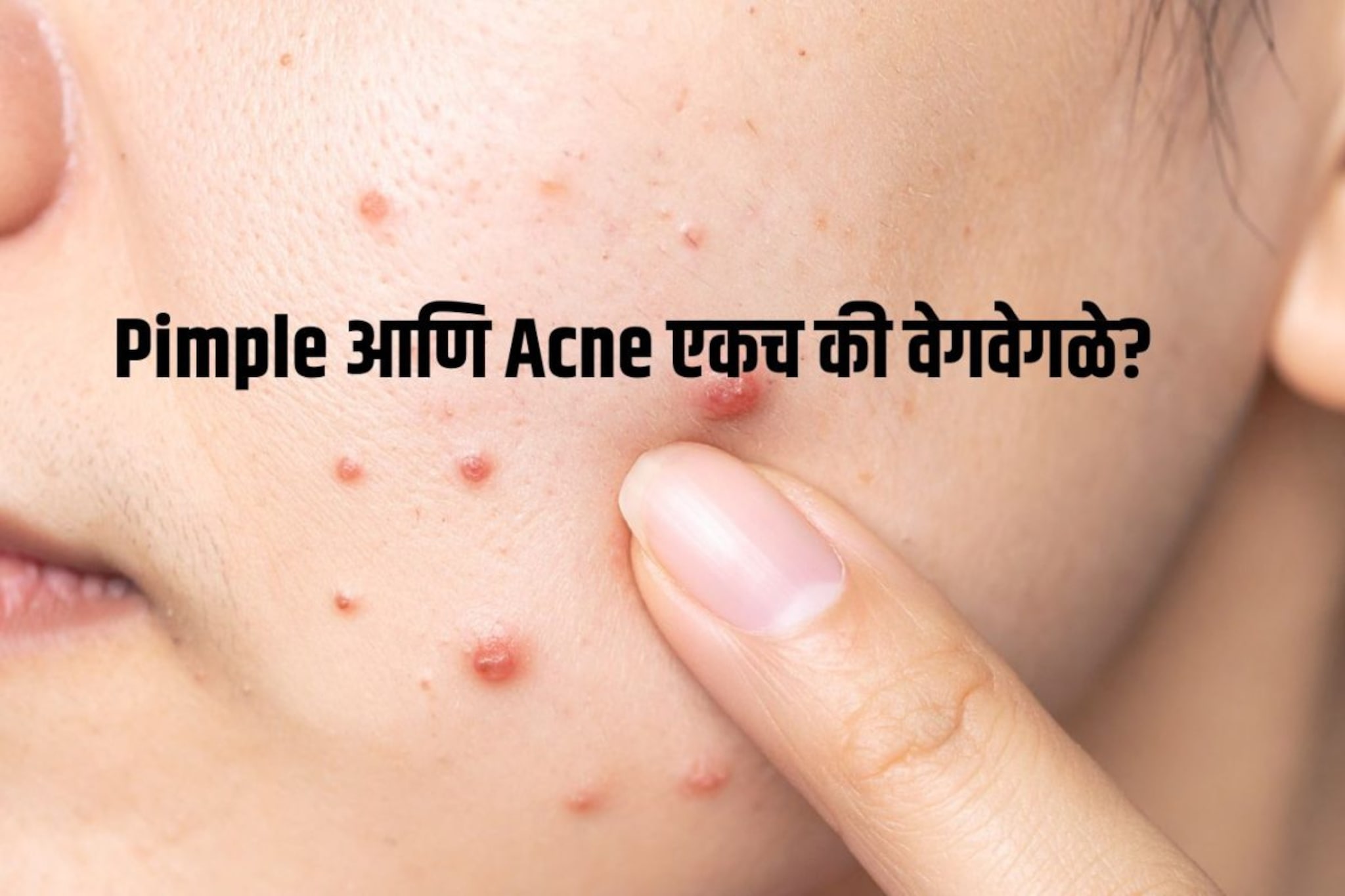 Pimple आणि Acne मध्ये फरक काय? Youtube बघून उपाय करण्यापूर्वी हा फरक जाणून घ्या Pimple आणि Acne मध्ये फरक काय? Youtube बघून उपाय करण्यापूर्वी हा फरक जाणून घ्या