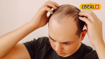 Hair Loss Woes? Doctors Reveal Causes & Solutions for Men & Women