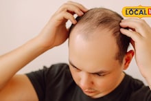 Health Tips : तुम्हीही केस गळतीने त्रस्त आहात? वेळीच करा हे उपाय, डॉक्टरांनी दिला महत्त्वाचा सल्ला