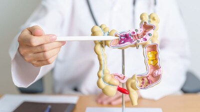 Colon Cancer: Don't Ignore Abdominal Pain, Fatigue; Early Signs You Need to Know