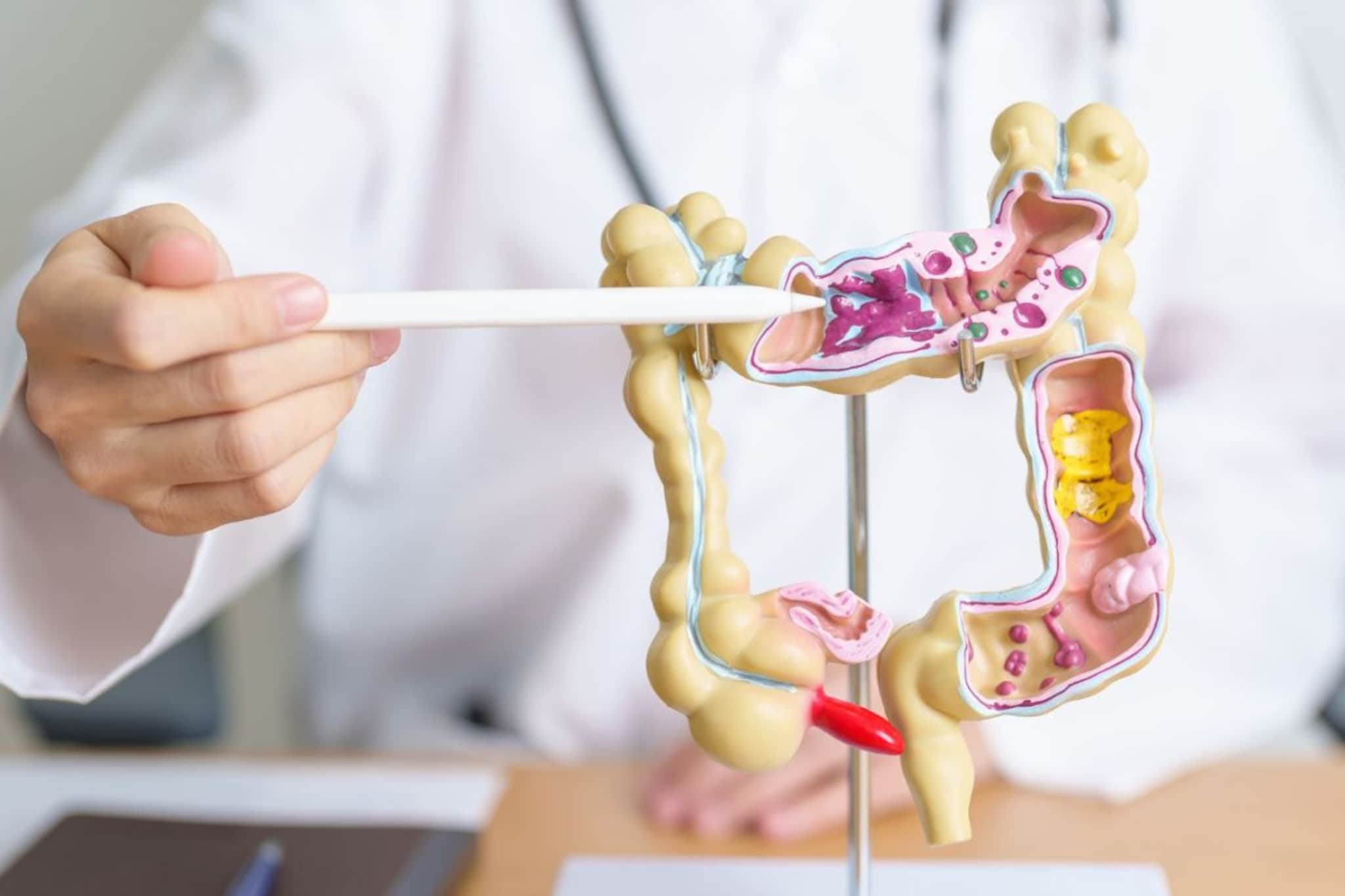 Colon Cancer : आतड्यांच्या कर्करोगाचं वाढतं प्रमाण, जाणून घ्या लक्षणं आणि कारणं Colon Cancer : आतड्यांच्या कर्करोगाचं वाढतं प्रमाण, जाणून घ्या लक्षणं आणि कारणं