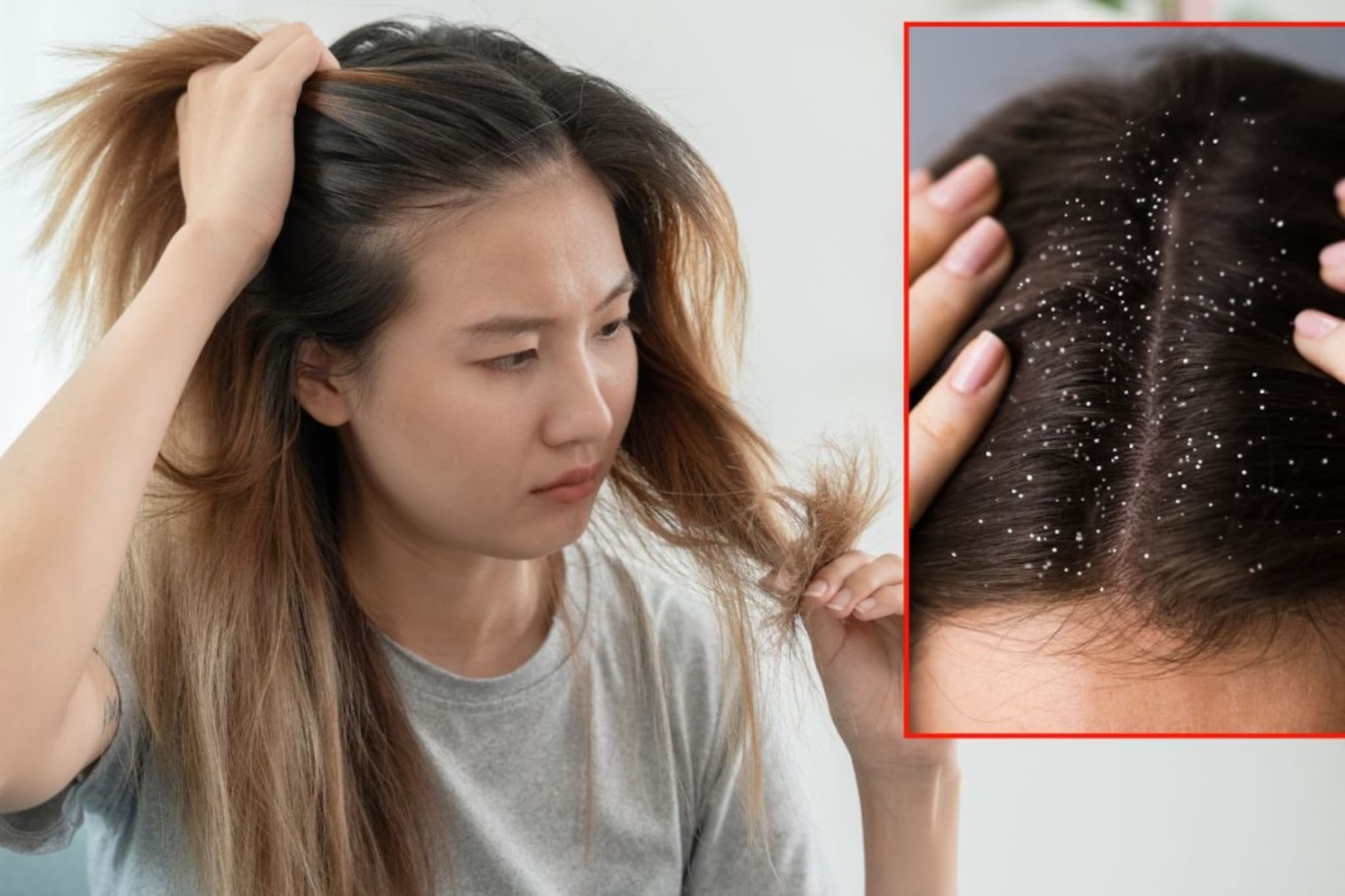 केसांतील कोंडा वाढतोय, शॅम्पूने केसही रुक्ष होतायंत? क्रिएटरने दिला घरगुती उपाय