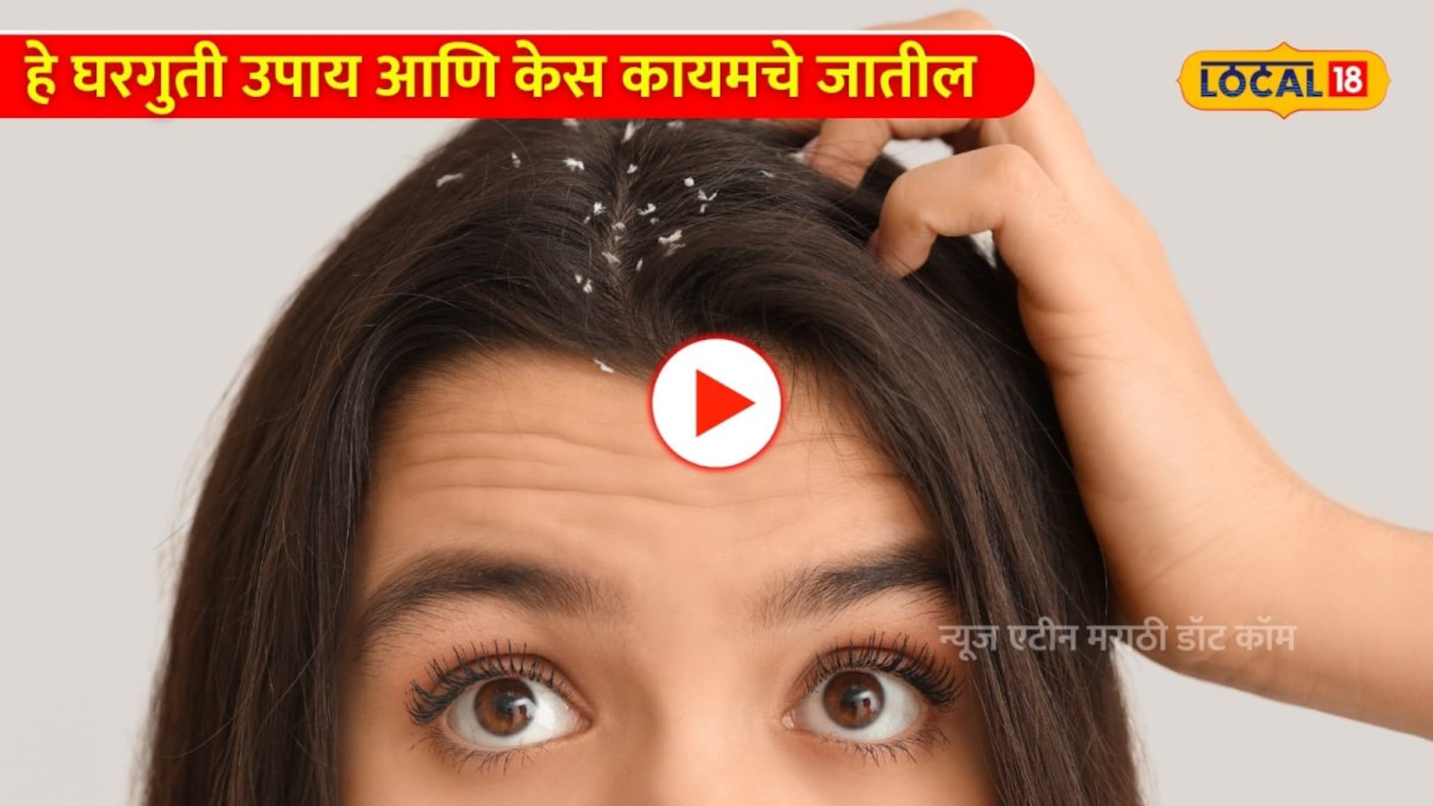 Dandruff: कोंड्यासाठी हे घरगुती उपाय आणि केस कायमचे जातील