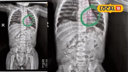 तुमच्या चिमुकल्याकडे दूर्लक्ष नको! छ. संभाजीनगरात 15 महिन्याच्या बाळानं खडा गिळला, पुढं जे घडलं.. तुमच्या चिमुकल्याकडे दूर्लक्ष नको! छ. संभाजीनगरात 15 महिन्याच्या बाळानं खडा गिळला, पुढं जे घडलं..