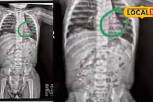 तुमच्या बाळाची काळजी घ्या! छ. संभाजीनगरात 15 महिन्यांच्या चिमुकल्यानं खडा गिळला अन्...