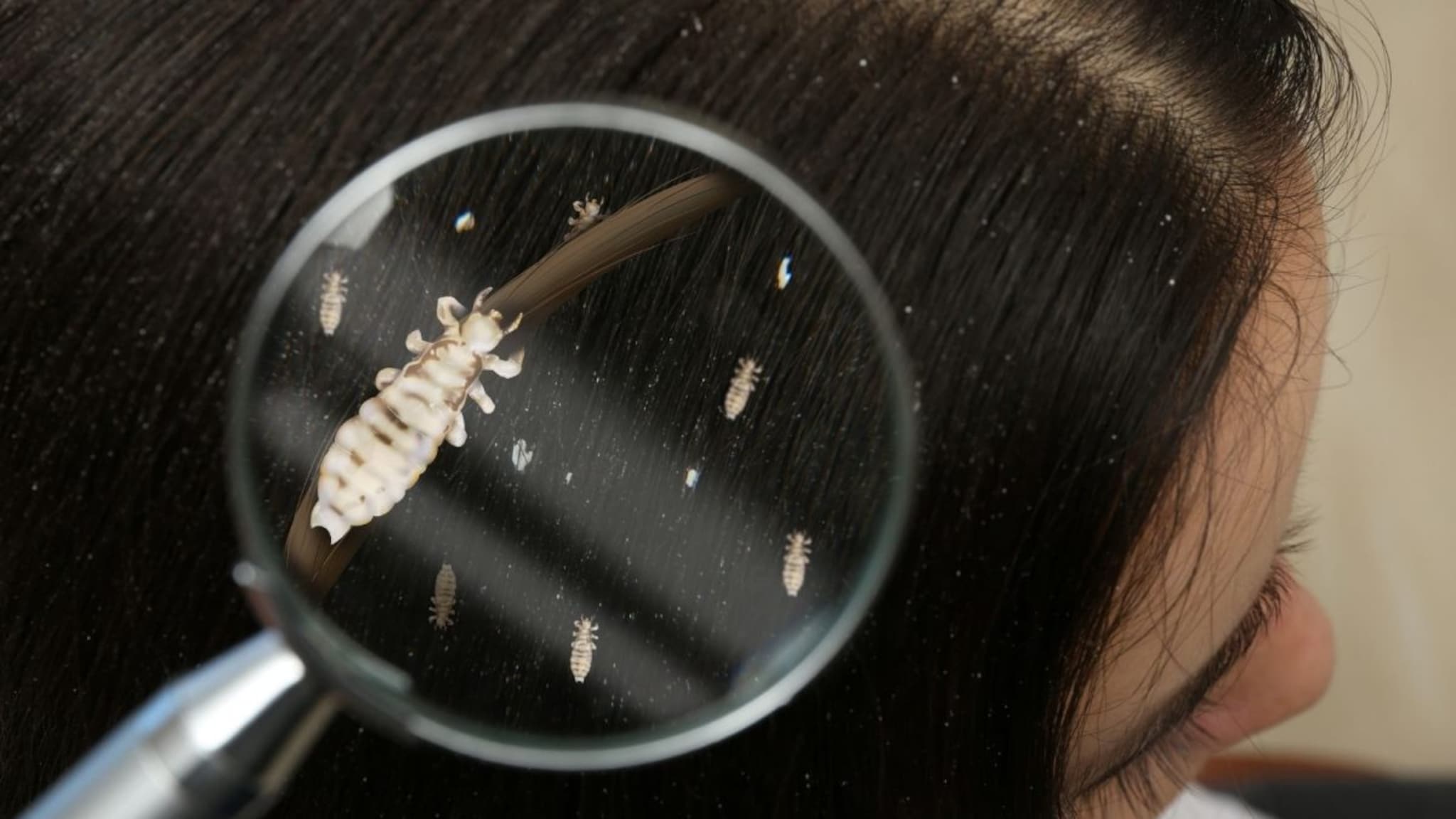 Lice : डोक्यांमधील उवांमुळे चिमुकलीचा मृत्यू, नेमकं काय आणि कसं घडलं? समोर आला धक्कादायक प्रकार