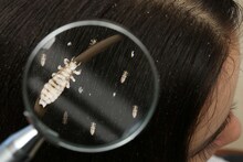 Lice : डोक्यांमधील उवांमुळे चिमुकलीचा मृत्यू, नेमकं काय आणि कसं घडलं? समोर आला धक्कादायक प्रकार