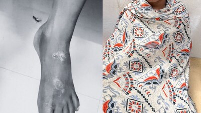 छत्रपती संभाजीनगर में पिता ने 8 साल की बेटी से किया दुर्व्यवहार, शरीर पर मिले जलने के निशान.