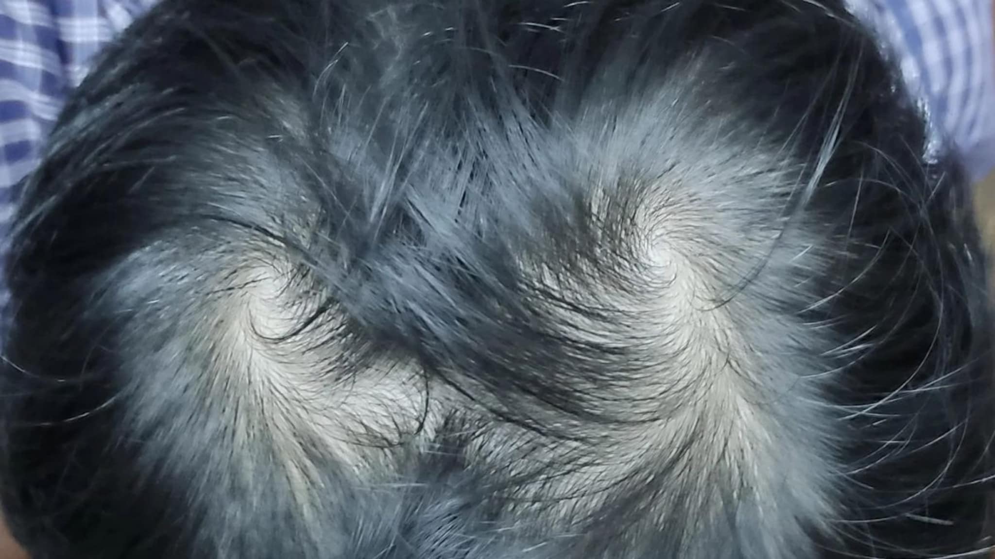 Two whorl on Head : डोक्यावर दोन भोवरे असणाऱ्यांचे दोन लग्न होतात? ही अफवा की वास्तव? वाचा सविस्तर