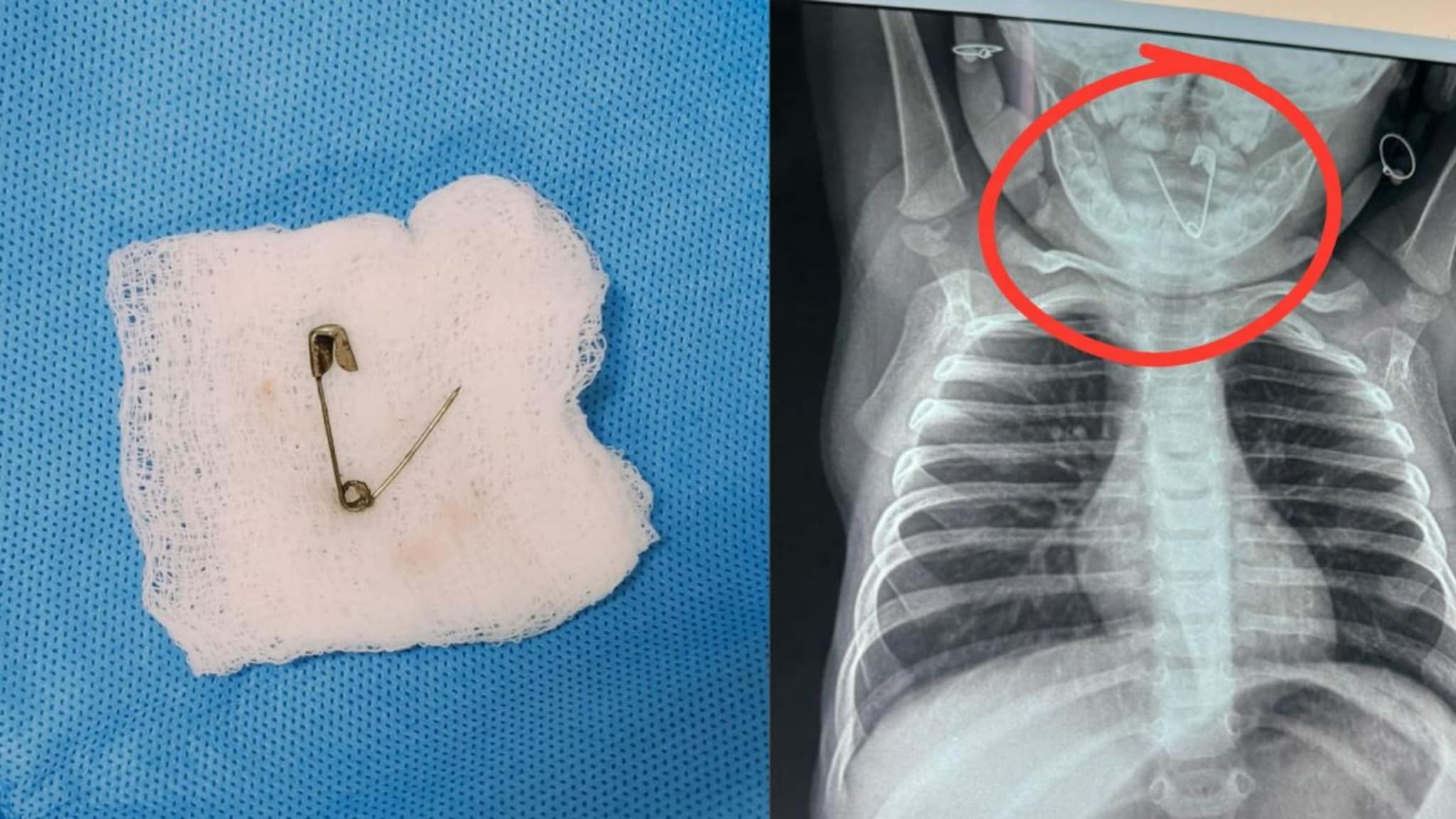  सात महिन्याच्या बाळाच्या घशात अडकली सेफ्टी पिन, महिन्याभरानंतर समोर आली धक्कादायक बाब; डॉक्टर म्हणाले...