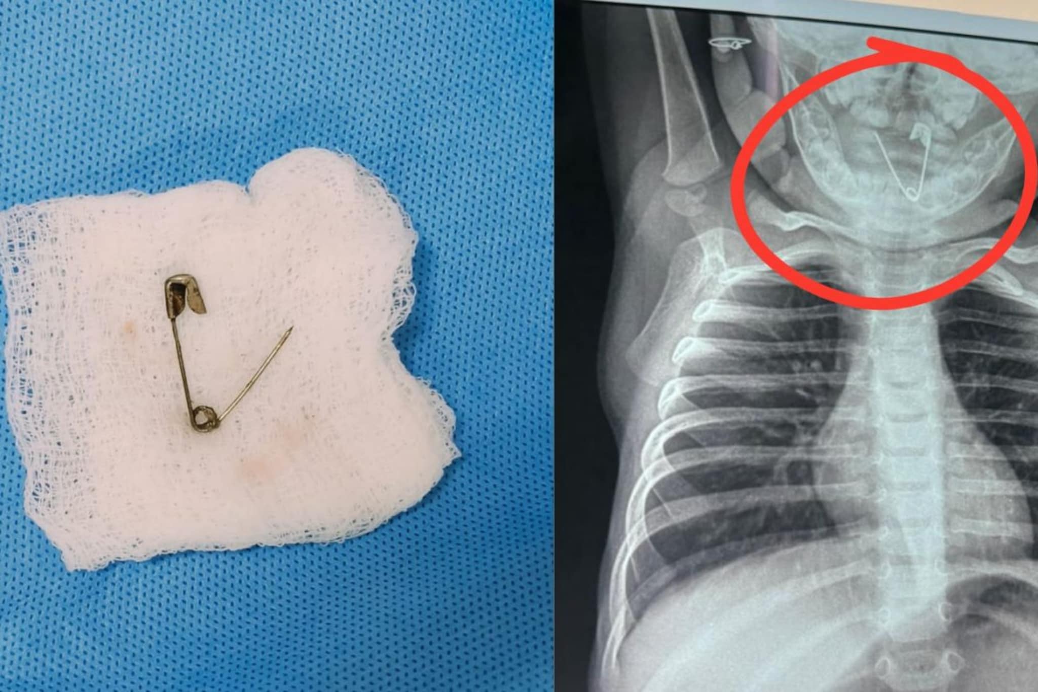  सात महिन्याच्या बाळाच्या घशात अडकली सेफ्टी पिन, महिन्याभरानंतर समोर आली धक्कादायक बाब; डॉक्टर म्हणाले...