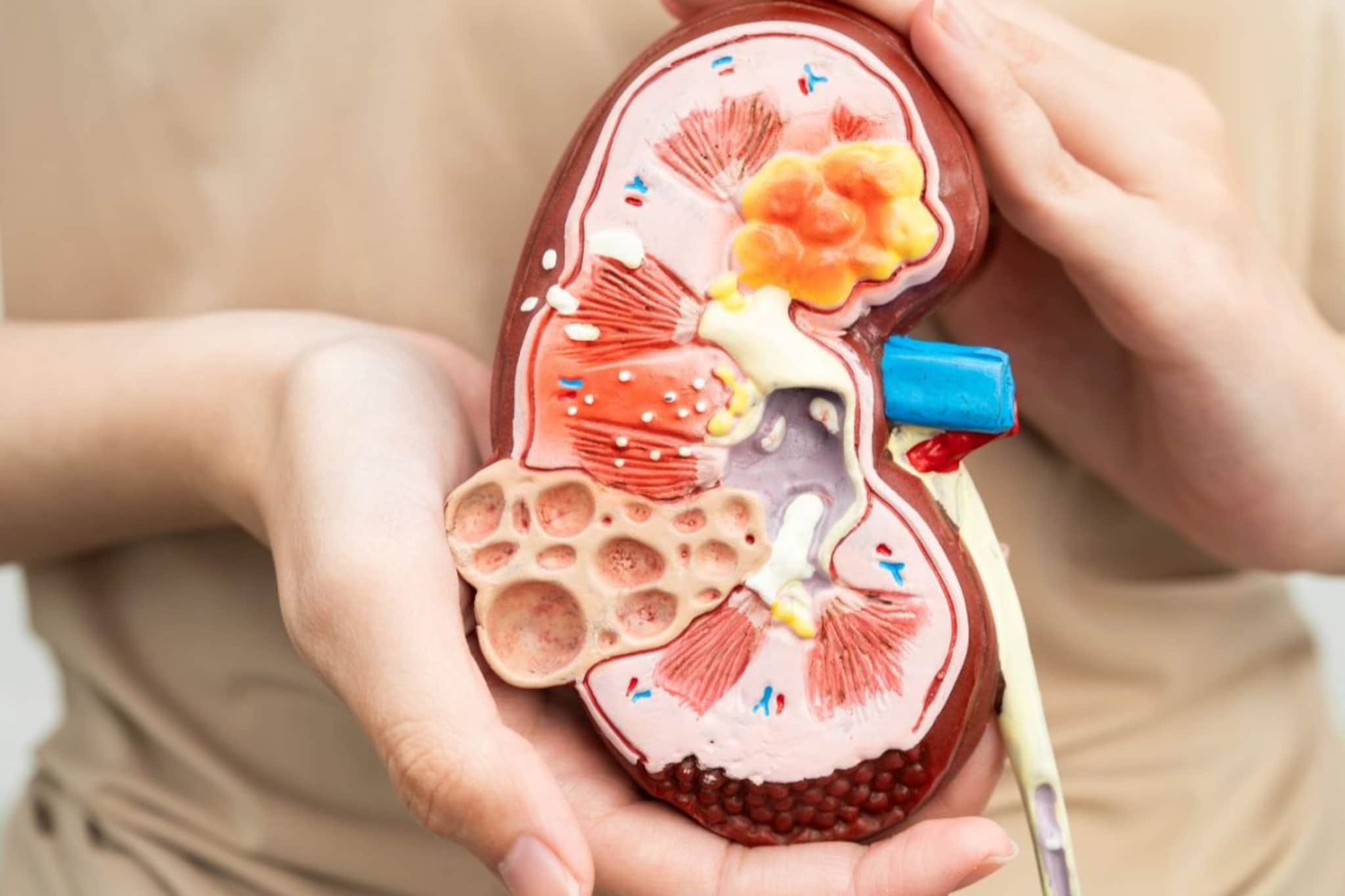 Kidney Stone : उन्हाळ्यात वाढतो किडनी स्टोनचा धोका, उन्हाळ्यात घ्या विशेष काळजी