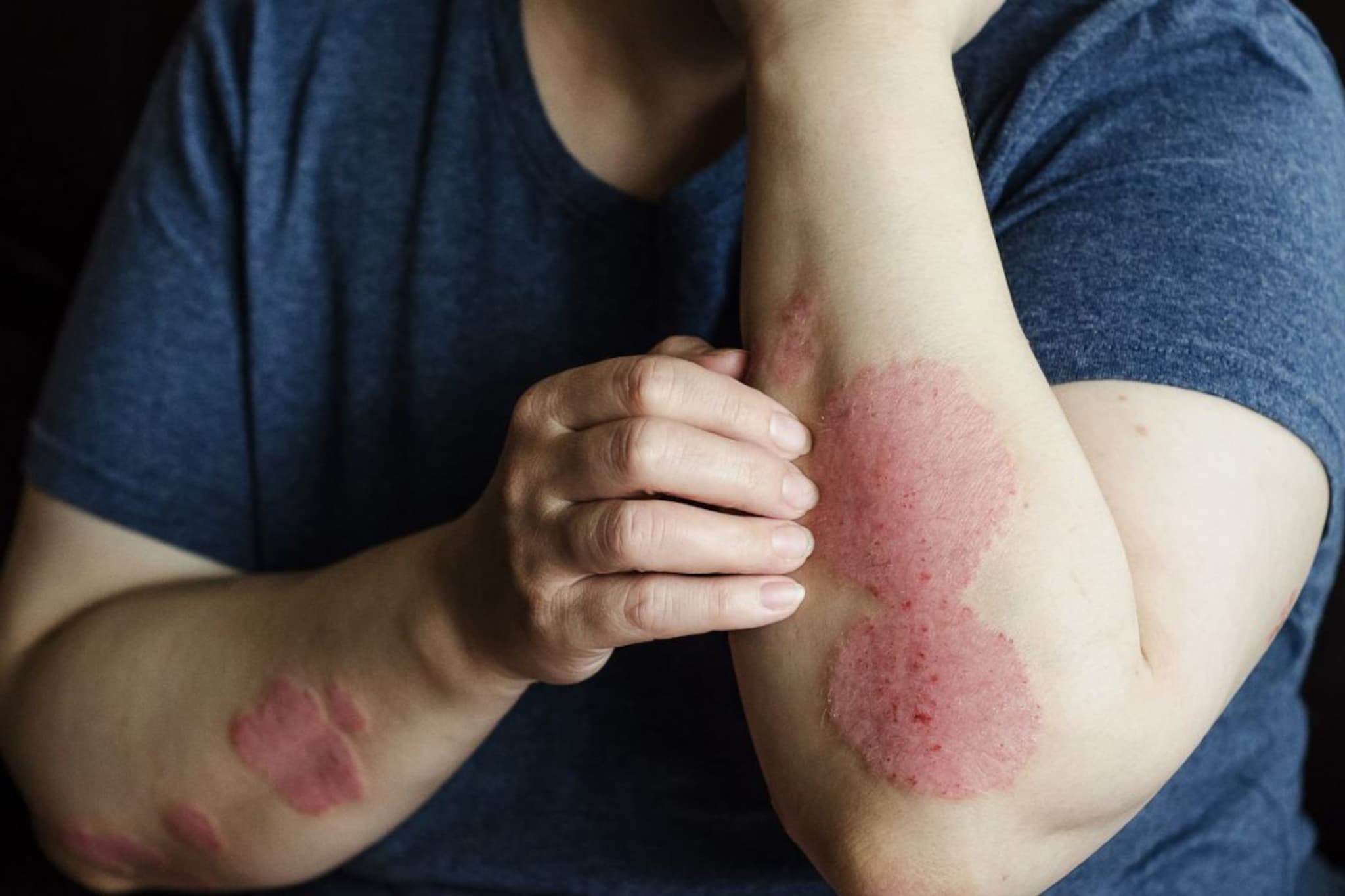 Psoriasis : त्वचा विकारांचा मनावर काय परिणाम होतो ? यावर मात करण्यासाठी कोणते उपचार करायचे ?